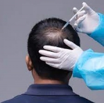 Restore Confidence with PRP Hair Therapy