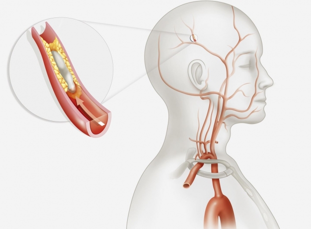 Breakthroughs in Stroke Recovery with Stem Cell Therapy in India