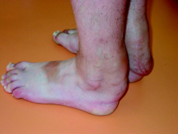 Evolving Cerebrotendinous Xanthomatosis Market Growth and Dynamics
