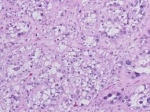 Clear Cell Ovarian Cancer Market Size  Growth Trends