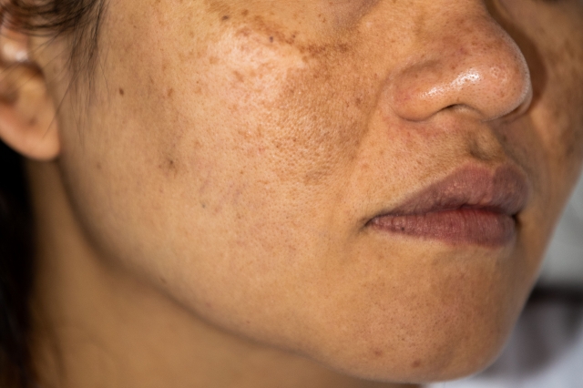 Who Needs Pigmentation Treatment?