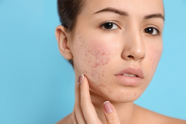 Cost vs. Results: Acne Scar Treatment in Islamabad Explained