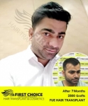 Reviving Confidence with Expert Hair Solutions in Punjab: Trusted Clinics in Chandigarh & Ludhiana