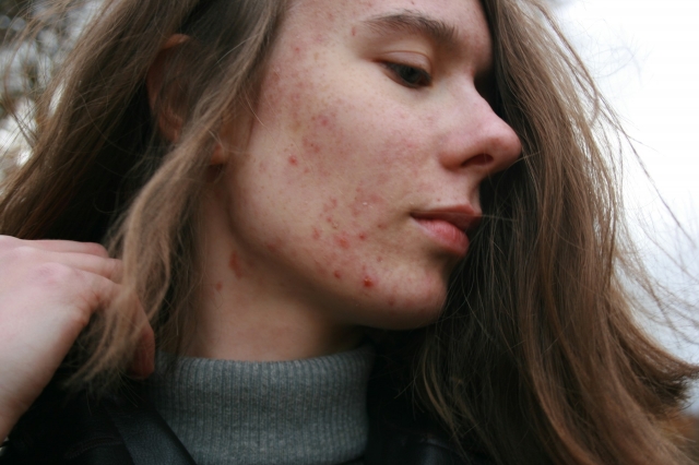 How Sleep Affects Skin Repair: Why Rest Matters for Acne Scar Recovery