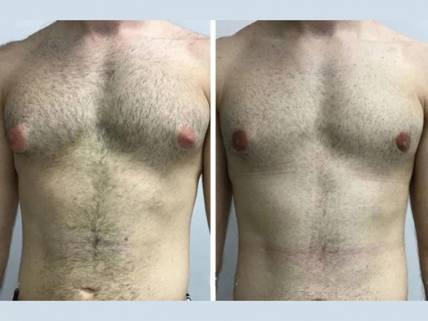Gynecomastia in Dubai: What Makes It a Popular Destination for Treatment?