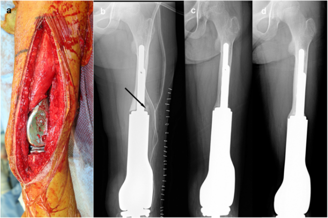 Understanding the Osteosarcoma Surgery Cost in India