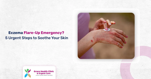 Dealing with an Eczema Flare-Up? 5 Urgent Steps to Calm Your Skin