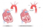 Coarctation Of The Aorta in India: Advanced Treatment, Excellent Outcomes, and Affordable Costs