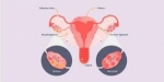 Regain Natural Ovulation: Laparoscopic Ovarian Drilling in India for PCOS