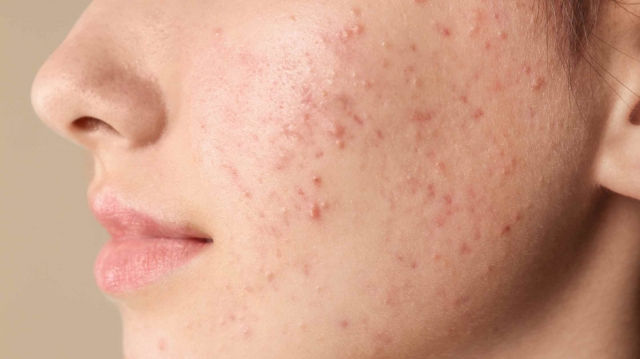 Radiant Skin & Perfect Brows: Expert Insights into Acne Scar Treatment in Mumbai