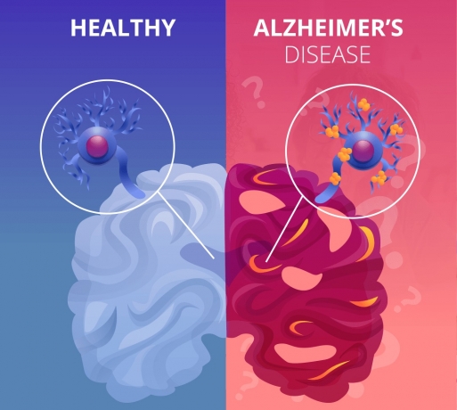 Exploring Alzheimer Stem Cell Therapy in India: A New Hope