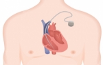 Global Implantable Cardiac Monitors Market Size and Growth Outlook 2025-2032