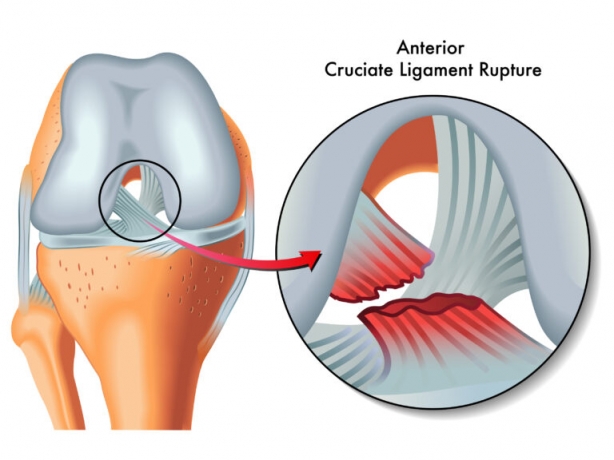Anterior Cruciate Ligament Injuries Market Growth and Future Outlook