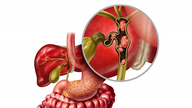 Biliary Tract Cancers (BTCs) Market Size and Growth Forecast 2025-2032.