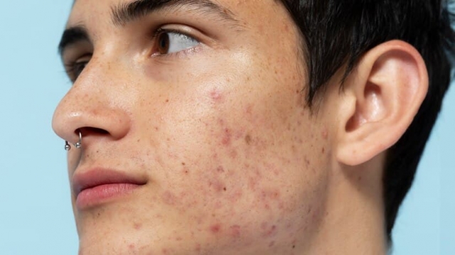 Clear Skin Starts Here: Acne Treatments in Birmingham That Work