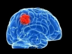 Glioblastoma Market Size, Trends, and Growth Forecast 2025-2032