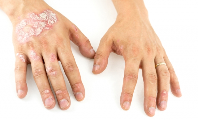Chronic Plaque Psoriasis Market Size, Trends, and Growth Analysis 2025-2032