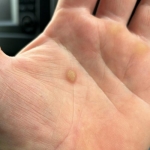 How to Care for Your Skin after Wart Removal?