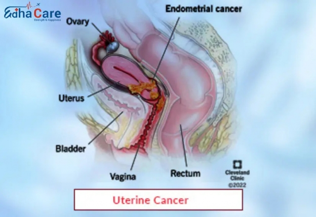 Espoir et expertise : le Traitement du cancer de l'utérus en Inde