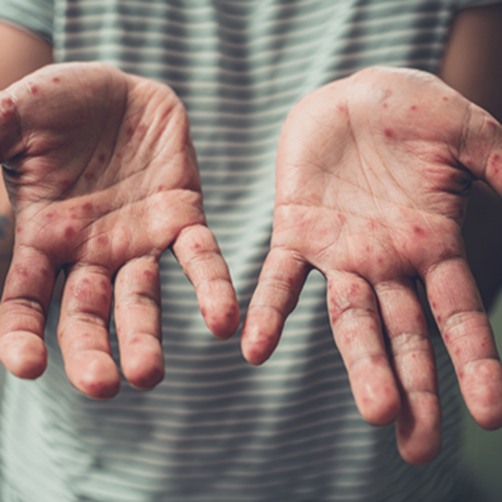 Hand Foot Syndrome Market: Size, Trends, Growth, and Key Players Analysis