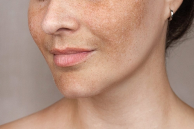 How To Remove Pigmentation From Face Permanently and Be Smooth