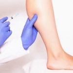 What Are The Benefits Of Microneedling For Acne Scars?