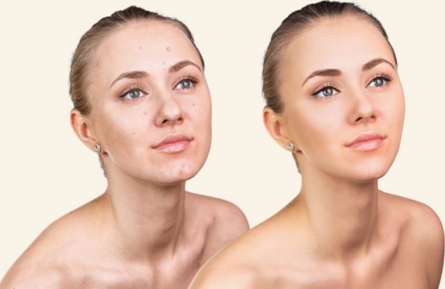 Clear Skin Journey: Proven Acne Scar Treatment in Delhi