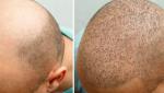 Hair Transplant in Islamabad: A Fresh Start for Hair and Confidence