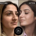 PRP Treatment in Dubai: Say Goodbye to Wrinkles and Fine Lines