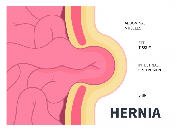 What Can Cause a Hernia? Diet, Age, and Genetics Explained