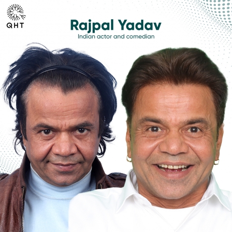 Best Hair Transplant Clinic in India – Why QHT Clinic Stands Out