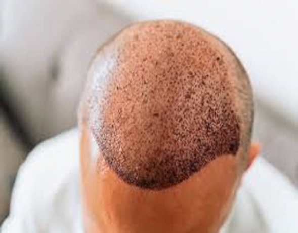 FUE & FUT Hair Transplants Now Available in Islamabad