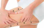 Thigh Skin Removal for Improved Mobility and Comfort