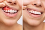 How Much Does Gum Contouring Cost?