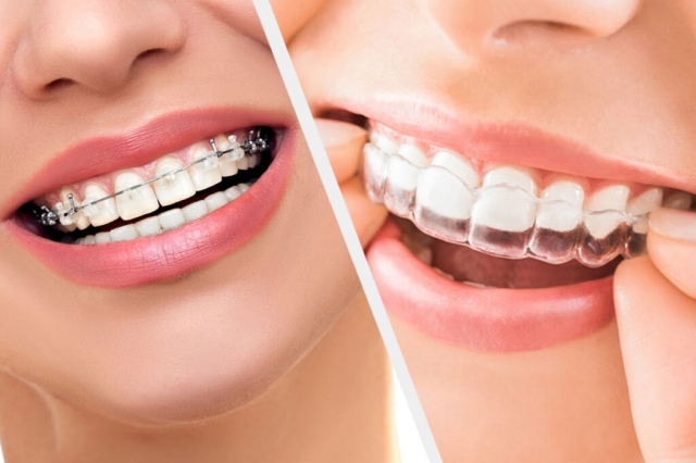 The Clear Path to a Perfect Smile