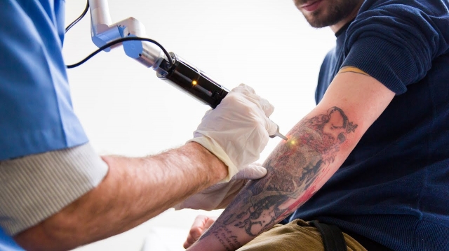 Laser Tattoo Removal for Sensitive Skin in Islamabad