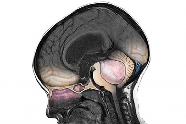 Global Medulloblastoma Drug Market: Size, Trends, Growth & Forecast (2025-2032)