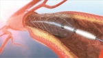Japan Coronary Stents Market Size Share Growth Forecast 2025-2033