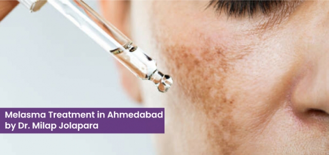 Melasma Treatment in Ahmedabad by Dr. Milap Jolapara
