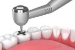 Does Insurance Cover Amalgam Filling Removal?