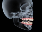 Restore Your Smile with All-on-4 Dental Implants in North Phoenix