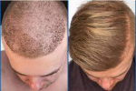 7 Months After Hair Transplant