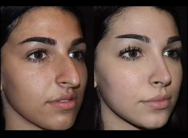 Septoplasty in Dubai: A Guide to Clearer Breathing