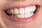 What’s the Difference Between Whitening and Stain Removal?