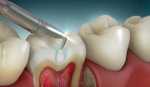How to Care for Your Teeth After Getting Dental Fillings