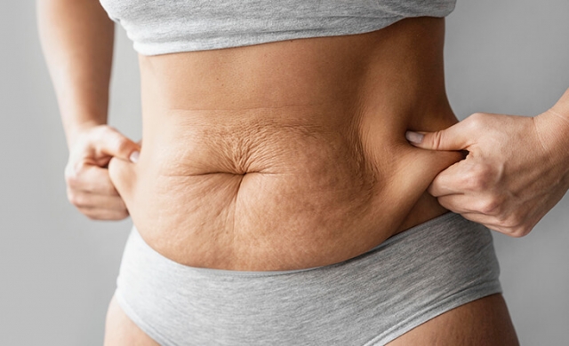 Does Tummy Tuck Address Both Fat and Loose Muscles?