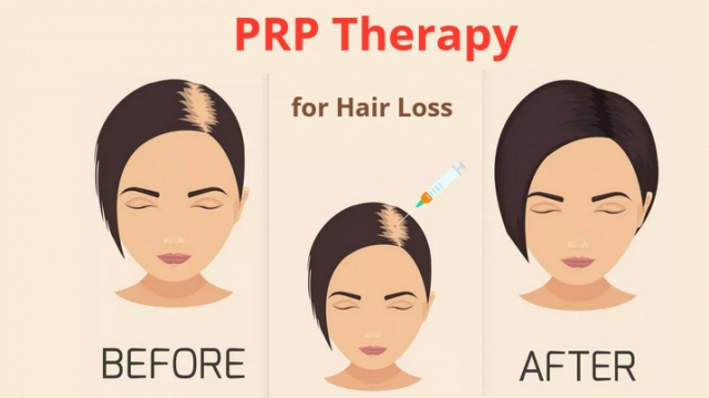 PRP Therapy for Hair Restoration in Delhi – Regrow Naturally at Derma Station