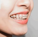 What Are the Different Types of Dental Retainers?