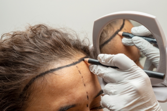 Hair Transplant That Delivers Real Hair Flow Again
