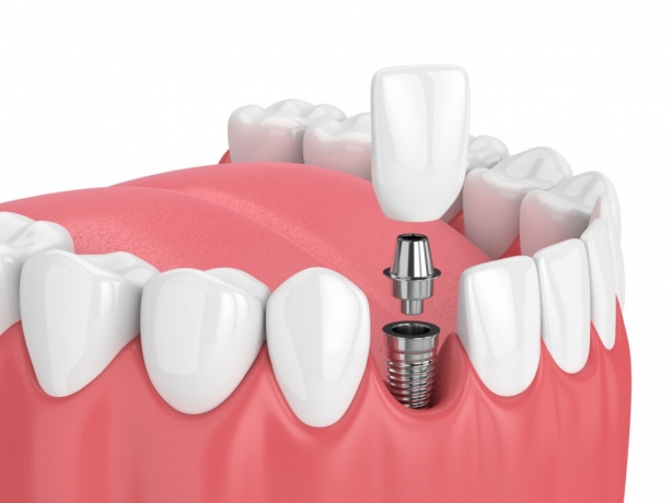 What Is the Step-by-Step Dental Implant Procedure?